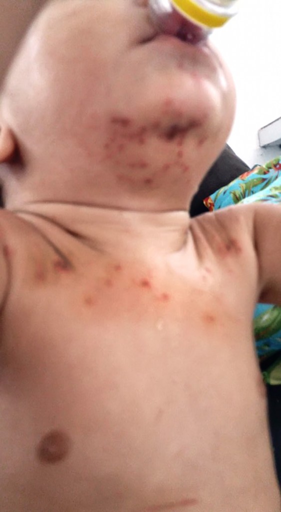 Criança com manchas e feridas, marcas da doença que chegou a região (Foto: Divulgação)