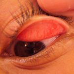 Guaratinguetá conscientiza população sobre o tracoma